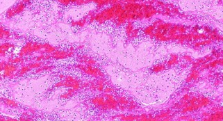 Millions raised for development of new anticoagulant medication with miracle properties