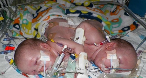 Miracle 26-hour surgery to separate conjoined twin girls to be aired on Nightline