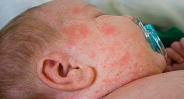 Measles infects 5 infants at Illinois daycare