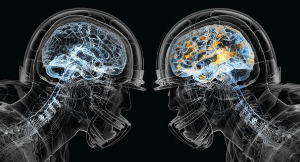 Study: Concussions may lead to Alzheimers