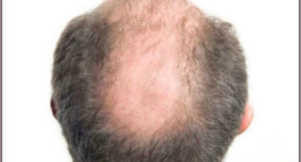 Want to fix balding? Yank out the hair you have left, study says