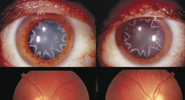 After electrical shock, man has star-shaped cataracts