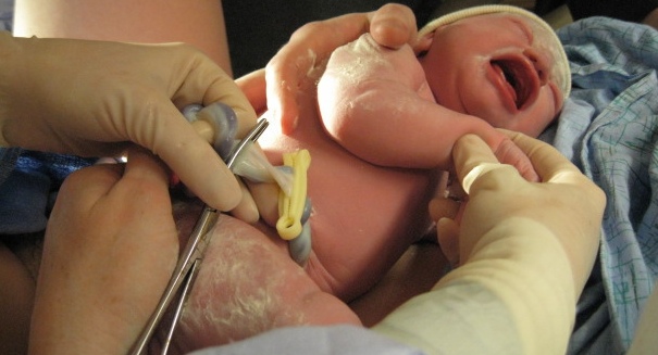 Later clamping of umbilical cord may benefit babies, researchers say